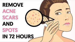 How to Get Rid of Acne Scars and Spots in 72 Hours [upl. by Terhune664]