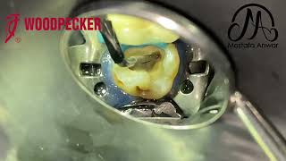 Access Cavity Refinement using Woodpecker D600 Ultrasonic Device in Upper Second Molar  Endodontics [upl. by Akkina]