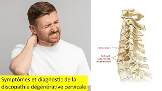 Symptômes et diagnostic de la discopathie dégénérative cervicale [upl. by Ytissac569]