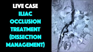 Live Case Aortoiliac Intervention with Dissection Management Discussion [upl. by Kcirderf]