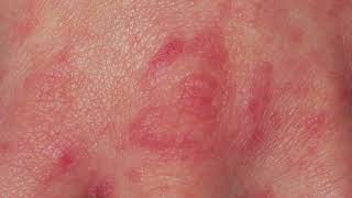 DO YOU HAVE SCABIES CLOSE LOOK AT THE SCABIES RASH [upl. by Naux497]