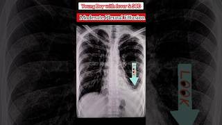 Pleural Effusion on XRay Chest 🩻 medical xray diagnosis radiology ultrasound shorts [upl. by Nitsruk261]