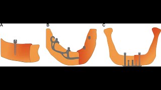 PART2IMPLANTS IN ORTHODONTICS TAD TEMPORARY ANCHORAGE DEVICESINTRO PART 2 [upl. by Girish]