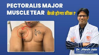 Pectoralis Major Muscle Tear कैसे होगा ठीक  Bench Press Injury  Dr Jitesh Jain [upl. by Noskcaj122]