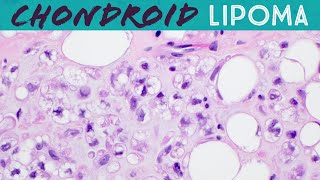 Chondroid lipoma has lipoblasts but not liposarcoma Basic soft tissue pathology [upl. by Kimber367]