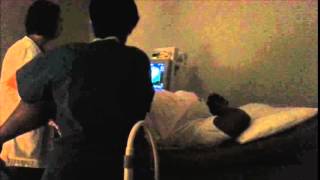 Saline Infusion Sonohysterography SIS VIDEO [upl. by Syramad]