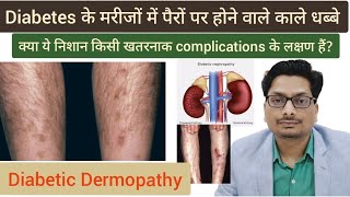 Diabetes के मरीजों में पैरों पर होने वाले काले धब्बे  Diabetic Dermopathy diabetes diabeticcare [upl. by Engel]