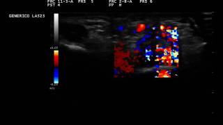 Dactylitis ultrasound [upl. by Lambert]