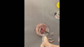 Removal of a Cervical Polyp [upl. by Eidualc]