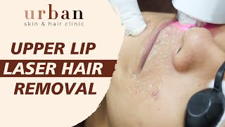 Upper Lip Laser Hair Removal Treatment  Urban Skin amp Hair Clinic [upl. by Nomyt]