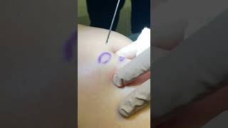 Treating Cellulite with Subcision [upl. by Vivi]