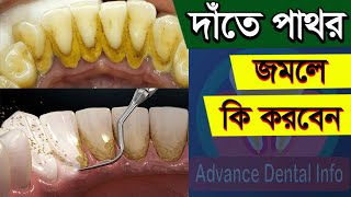 দাঁতের পাথর দূর করার উপায়  Date Pathor Dur Korar Upay  Teeth Stone Removal At Home In Bangla [upl. by Verlee]