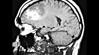 Diagnosis and Treatment of Infective Endocarditis [upl. by Linnette]