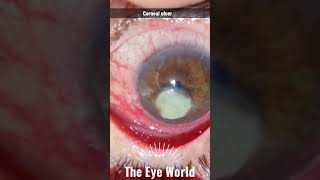 corneal ulcer [upl. by Montfort]