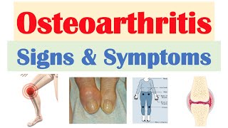 Osteoarthritis Signs amp Symptoms amp Why They Occur [upl. by Halyk]