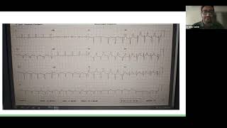 04 07 2024 Case Presentation Cirrhotic Patient for Right Hepatectomy [upl. by Hakaber]