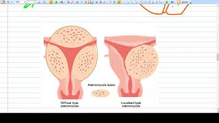 Adenomyosis  Concept  Diagnosis Management [upl. by Jerald]