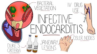 Infective Endocarditis With Duke Criteria amp Pathophysiology [upl. by Atiugram]