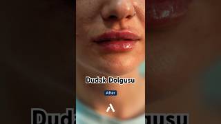 🫦 Dudak Dolgusu Öncesi Sonrası 🫦 dudakdolgusu lipfiller [upl. by Datnow895]