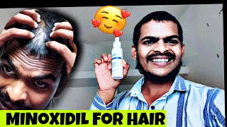 I BOUGHT MINOXIDIL FOR HAIR REGROWTH 🙂😥 [upl. by Rubia509]