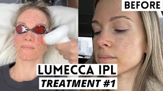 LUMECCA IPL  BEFORE amp AFTER  VLOG [upl. by Irmine106]