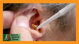 Dr Gawayne Cleans Ears After Bells Palsy  Auburn Medical Group [upl. by Nauqaj147]