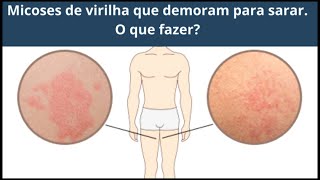 Micoses de virilha que demoram para sarar O que fazer [upl. by Farrington]