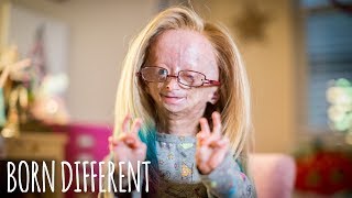 Adalia Rose The Girl Who Ages Too Fast  BORN DIFFERENT [upl. by Chrisy753]