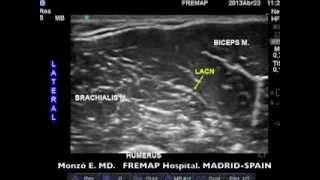 Echoanesthesia Today Lateral Antebrachial Cutaneous Nerve [upl. by Shelby]