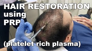 Scalp Hair Restoration using Platelet Rich Plasma  West End Plastic Surgery [upl. by Lamahj]