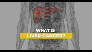 LIVER CANCER  SYMPTOMS RISK FACTORS PREVENTION [upl. by Adnuhsor]