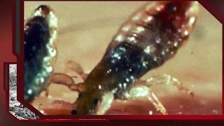 Body lice  أخطر أنواع القمل قملة الجسم [upl. by Yerahcaz]