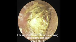 Ear wax removalFungus cleaning 耳垢清除和真菌清理20230910 [upl. by Sevy]