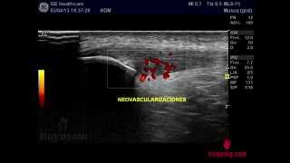 Tratamiento Tendinitis Rotuliana con EPI  Electrólisis Percutánea Intratisular [upl. by Lucille]