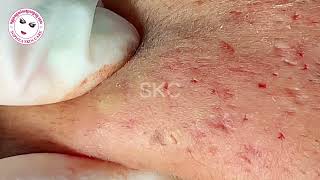 Acne facial removal treatment by Sopheaskincare 29th October 2023 [upl. by Oiramed545]