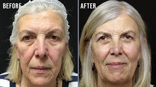 How does a NonSurgical Facelift work Susans Vivalift Explained [upl. by Drawoh]