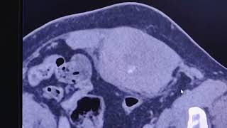 Rectus sheath hematoma  CT findings [upl. by Emylee]