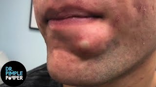 SATISFYING Dr Lee Pops Inflamed Cyst on Chin  Dr Pimple Popper Reacts [upl. by Gallenz]