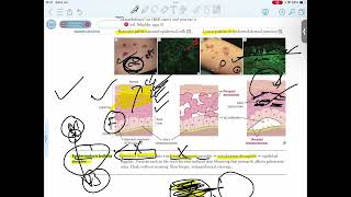 EPIDERMOLYSIS BULLOSA SIMPLEX [upl. by Ahcsat]