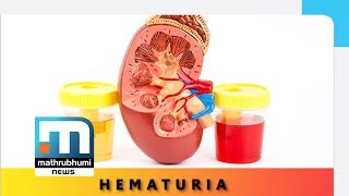 Hematuria Causes And Treatment Doctor  2 PM Mathrubhumi News [upl. by Melisenda]