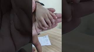 Polydactyly orthopedicshortcase pediatricorthopedics [upl. by Dnalrag217]