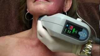 Exilis on Face amp Neck for Skin Tightening with Dr Seiler [upl. by Katy]