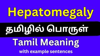 Hepatomegaly meaning in TamilHepatomegaly தமிழில் பொருள் [upl. by Anilra119]