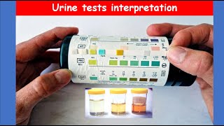 Lecture 72 Urine Analysis Tests  Interpretation [upl. by Ranson]