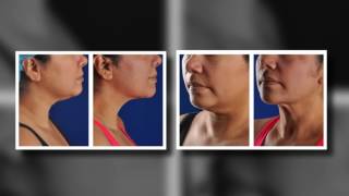 Phoenix Liposuction Results Female Chin [upl. by Wahlstrom]