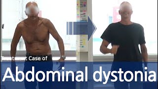 Abdominal wall dystonia  Truncal dystonia  Belly dancer’s dyskinesia  전신 사경증  근긴장이상증 [upl. by Analem]