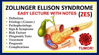 Zollinger Ellison Syndrome ZES Definition Causes Symptom Diagnosis Pathophysiology amp Treatment [upl. by Dzoba309]