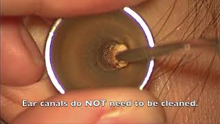 Ear Wax Extraction  St Pauls Hospital [upl. by Ahseim]