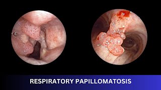 RESPIRATORY PAPILLOMATOSIS  Bronchoscopic Management [upl. by Gilus]