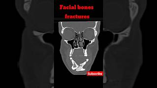 Facial Bones Fractures  CT Face shorts shortsfeed radiology ctface fracture [upl. by Hepsiba]